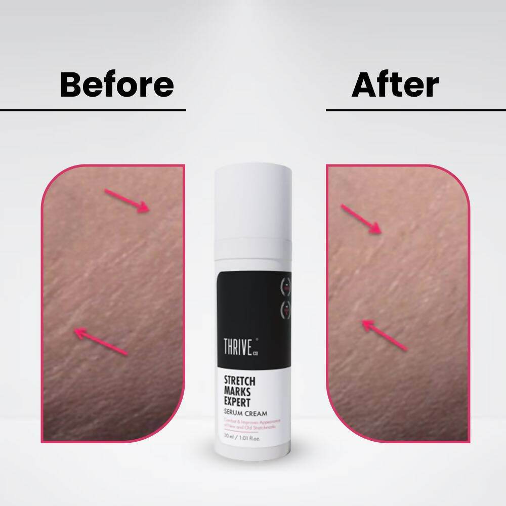 ThriveCo Stretch Marks Expert Serum Cream